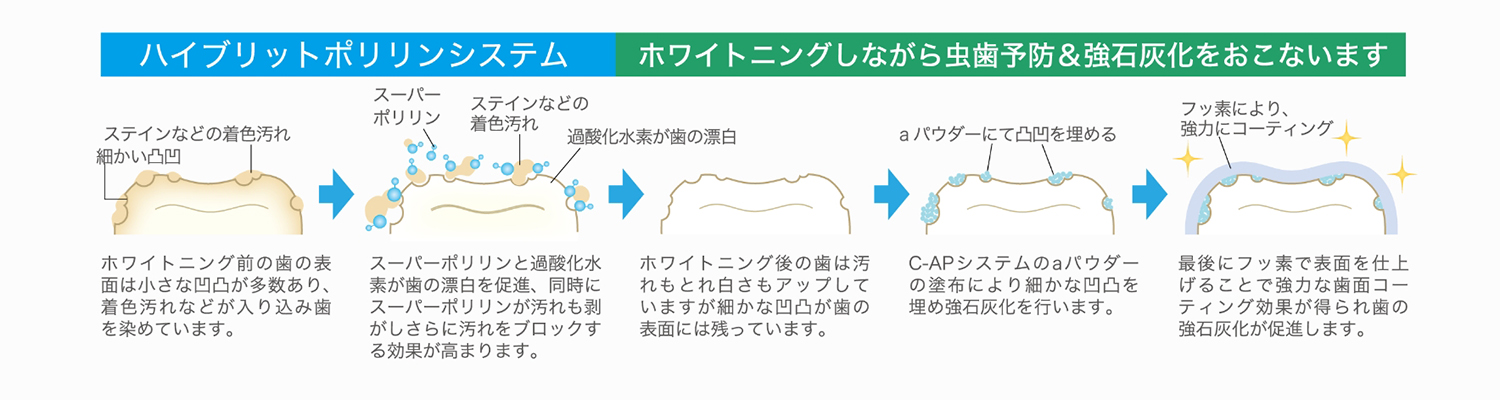 代々木の歯医者でホワイトニング