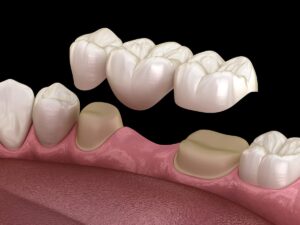 代々木クリスタル歯科医院で保険治療でも「白い歯」に。ブリッジ