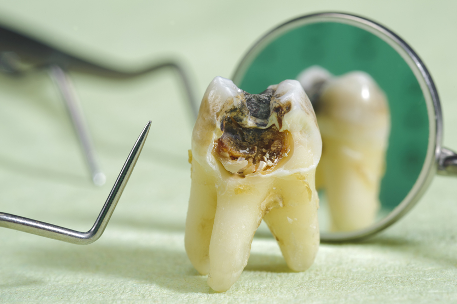 代々木の歯医者で虫歯治療