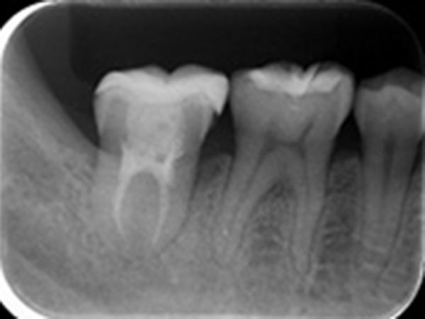 代々木の歯医者で自家歯牙移植