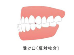 代々木の歯医者、代々木クリスタル歯科医院でマウスピース矯正ができない歯並びについての解説