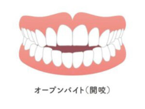 代々木の歯医者、代々木クリスタル歯科医院でマウスピース矯正ができない歯並びについての解説