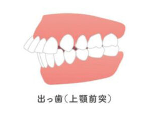 代々木の歯医者、代々木クリスタル歯科医院でマウスピース矯正ができない歯並びについての解説