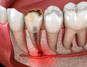 代々木の歯医者、 代々木クリスタル歯科医院で朝起きたときに歯が浮く感じについての解説