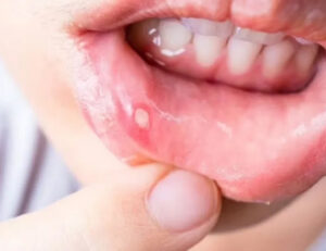 舌の先が赤くて痛いときに考えられる原因・病気を解説