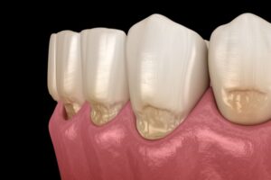 代々木の歯医者、代々木クリスタル歯科医院で硬いものは歯にどんな負担を与える？リスクや、奥歯のトラブルを起こしやすい理由を解説