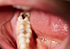 代々木の歯医者、代々木クリスタル歯科医院で歯の詰め物が取れた後に放置するとどうなる？リスクと予防法を解説