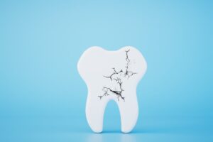 代々木の歯医者、代々木クリスタル歯科医院で硬いものを噛むと痛む？目に見えない歯のひび割れ（マイクロクラック）を解説